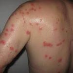 Bed Bug Bites — Pest Experts in Torquay Hervey Bay, QLD